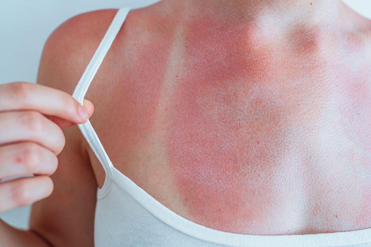 Sonnenbrand im Ostalbkreis: Vorbeugen, behandeln und richtig